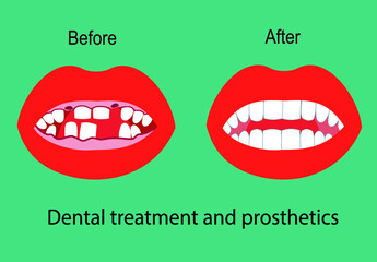Dental treatment and prosthetics graphic flat illustration. Dentistry and Orthodontics. Teeth before and after the doctor's treatment.The mouth is open