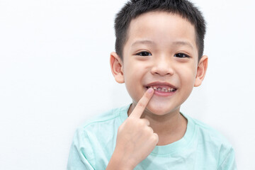Asian little boy was pointing at his permanent teeth are growing. A 5-year-old boy whose upper milk tooth incisor fell out. Kid happy open mouth showing cavities teeth decay.