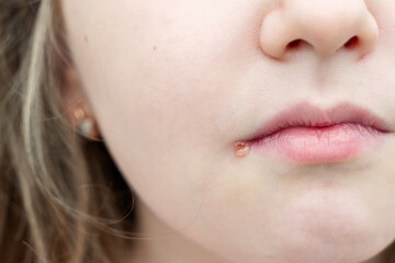 Close up photo of little girl lips affected by herpes. Treatment of herpes infection and virus. Part of kid face herpes affected. Beauty, cosmetology and dermatology concept.