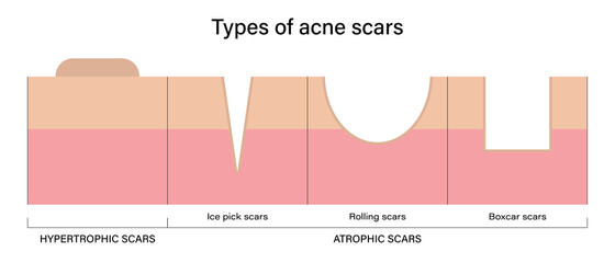 Types of acne scars vector.  Acne scar analysis