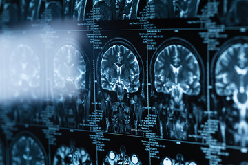 series of MRI images of head and brain, magnetic resonance imaging scan, world cancer day
