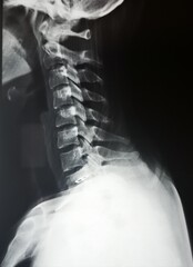 X-ray of neck and spine