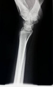 Human bone x-ray medical imaging