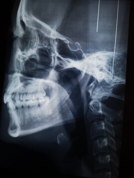 Medical x-ray of teeth