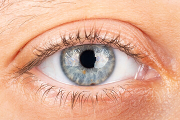 beautiful female eye, diagnosis of keratoconus corneal dystrophy