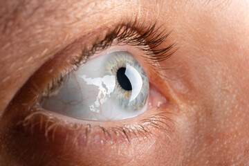 beautiful female eye, diagnosis of keratoconus corneal dystrophy