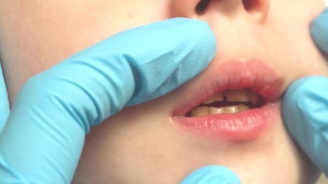 The doctor's hands in blue gloves show damage to the lip and gums on the baby's front teeth.