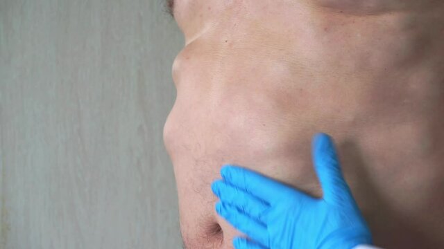 A doctor in blue rubber gloves and a white lab coat examines and palpates a man with lipomas - benign tumors on the body. multiple lipomas