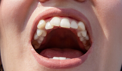 Curved female teeth, before installing braces. Close - up of teeth before treatment by an...