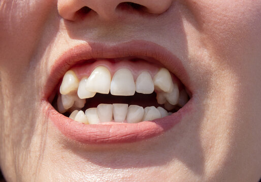 Curved female teeth, before installing braces. Close - up of teeth before treatment by an orthodontist