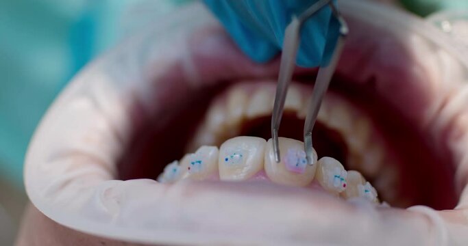 Close-up of an open mouth with optragate and on the tooth of the upper jaw is putting the ceramic brace.