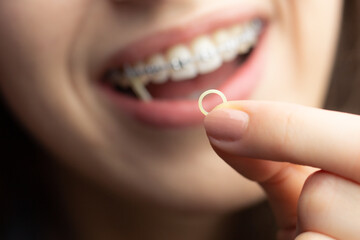 Closeup of a woman with braces wearing power chains and orthodontic elastics to correct her bite.