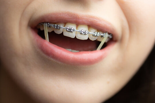 Closeup of a woman with braces wearing power chains and orthodontic elastics to correct her bite.