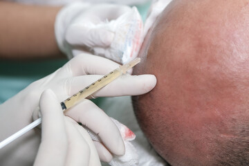 Balding man getting hair mesotherapy or scalp prp: Platelet-rich plasma procedure. Beautician doctor makes injections in the man head for hair growth against alopecia.