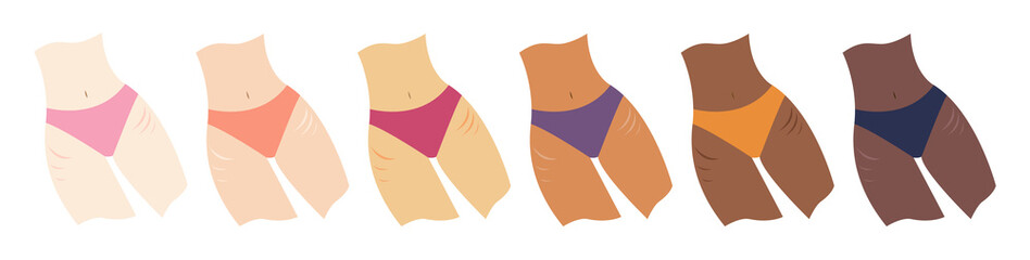 Female bodies with stretchmarks in tights. Women of with different shades of skin color in underwear with striae on legs. Body positivity, beauty, skincare concepts