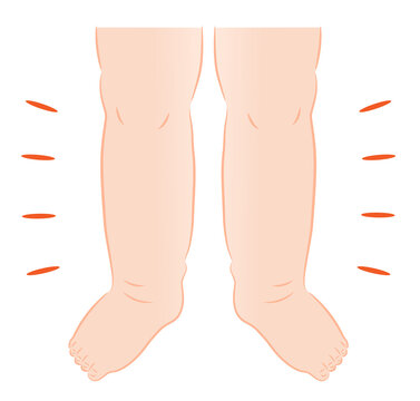 浮腫み ふくらはぎ の画像 8 件の Stock 写真 ベクターおよびビデオ Adobe Stock