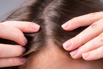 Close up of woman examining her scalp and hair, hair loss on hairline or dry scalp problem.