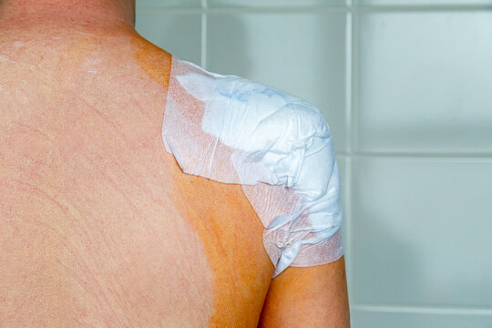 Verband nach einer Schulteroperation, nach einem Unfall