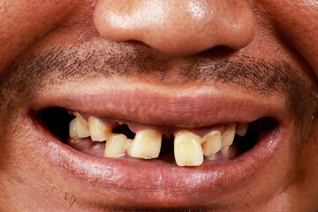 Obraz premium A man have oral health problems from smoking