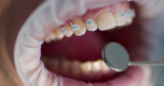 Close-up male open mouth with optragate and on teeth are ceramic braces. Teeth inspection by using a dental mirror.