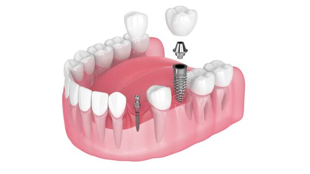 Lower jaw with two types of dental implants placement over white background