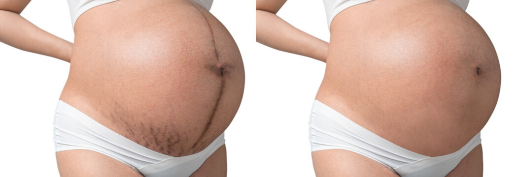 Pregnant Asian woman have Stretch marks on belly and clean belly, Isolated on white background, With clipping path, Before and after.