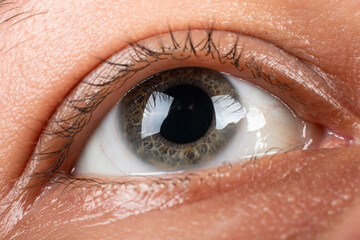 Keratoconus eye closeup , thinning of the cornea