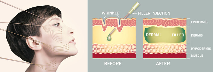 Treatment areas for anti-wrinkle injection. Young female with clean fresh skin. Beautiful woman....