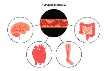 Types of ishemia - obrazy, fototapety, plakaty