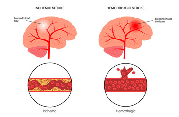 Brain stroke ishemic and hemorrhagic - 444617509
