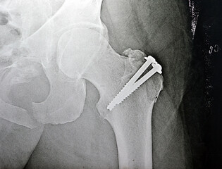 Selective focus of a plain x ray on left hip joined with a fracture of the greater trochanter of...