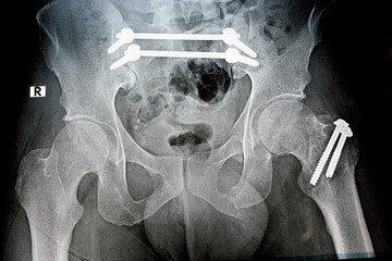 Plain x ray with a fracture pelvis that is fixed with 4 screws and 2 rods and fracture of greater...