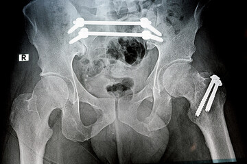Plain x ray with a fracture pelvis that is fixed with 4 screws and 2 rods and fracture of greater trochanter of femur fixed with 2 screws and fracture of symphysis pubis, ileo-iliac pelvic fixation - obrazy, fototapety, plakaty