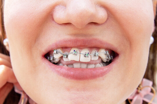 Curved female teeth, after installing braces. Close-up of the teeth after treatment at the orthodontist.Brasket system in a girl's smiling mouth, macro photography of teeth. Braces on the girl's teeth