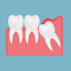 a molar tooth comes out of the gum and two healthy teeth