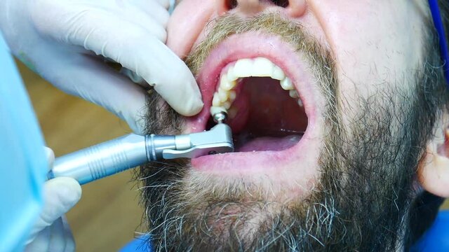 A dentist makes a professional teeth cleaning to a bearded man close-up