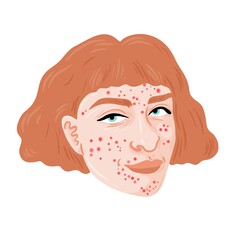 Portrait of a woman with white skin that is covered in Acne Pimples. She has brown hair.
