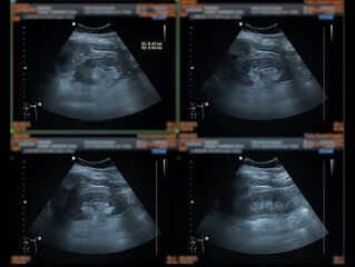 Ultrasound upper abdomen showing  Liver, gall bladder and kidney for screening abdominal disease.