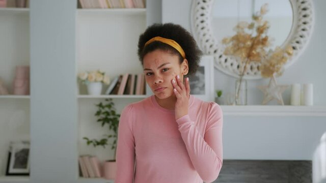 Young African American Teen Girl with Problem Skin Looks at the Camera Like in a Mirror. Acne treatment Time Lapse - 7th day of 28. Woman Skin Care Concept.