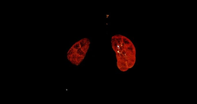 CTA Abdominal​ or CTA​ renal adtery 3D rendering image  showing both kidney.