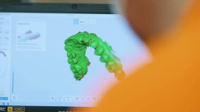 Close-up view of screen, Doctor, dentist makes a 3D scan of the teeth of a female patient, for treatment, patient's visit to the dental clinic