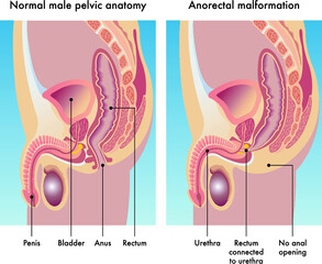 Medical illustration compares a normal male pelvic anatomy with one afflicted with anorectal malformation, with annotations. - obrazy, fototapety, plakaty