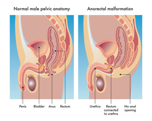 Medical illustration compares a normal male pelvic anatomy with one afflicted with anorectal malformation, with annotations.