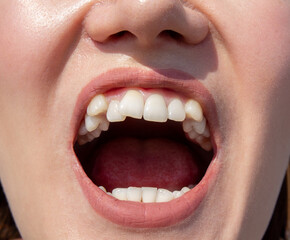 Curved female teeth, before installing braces. Close - up of teeth before treatment by an...