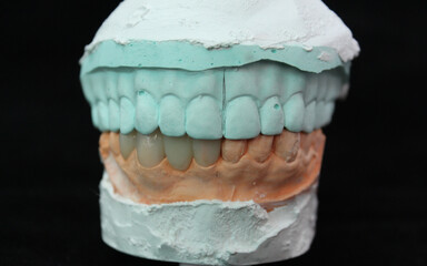 Dental crowns and veneers in the plaster model