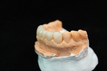 Fototapeta na wymiar Dental crowns and veneers in the plaster model