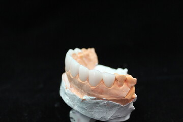 Fototapeta na wymiar Dental veneers for new smile