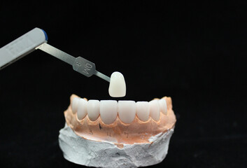 Fototapeta na wymiar Compare the color with shade guide of the veneer teeth for dental treatment