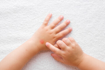 Baby girl finger pointing to itchy hand skin after mosquito bites on white towel background. Point...
