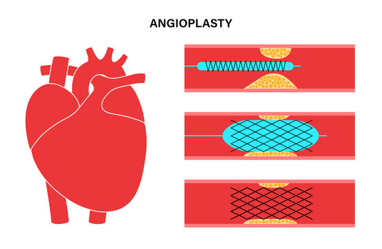 Angioplasty Cardiac Stent